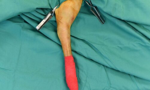 Żylaki powrózka nasiennego: objawy, diagnostyka i metody leczenia