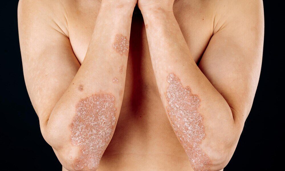 Jak rozpoznać łuszczycę na dłoniach i stopach: objawy, zdjęcia i leczenie
